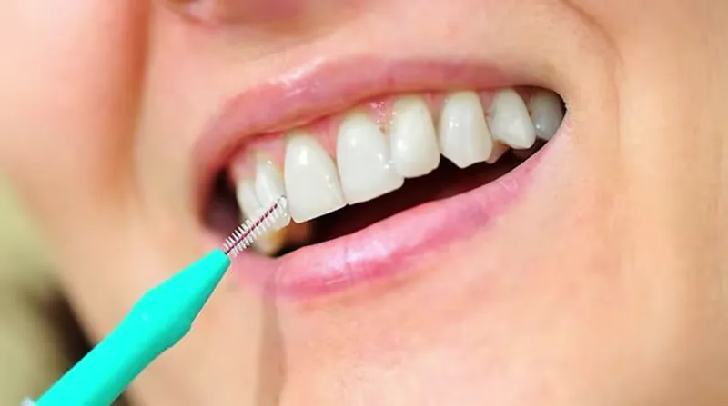 Frau wendet Interdentalbürsten zwischen Zähnen an